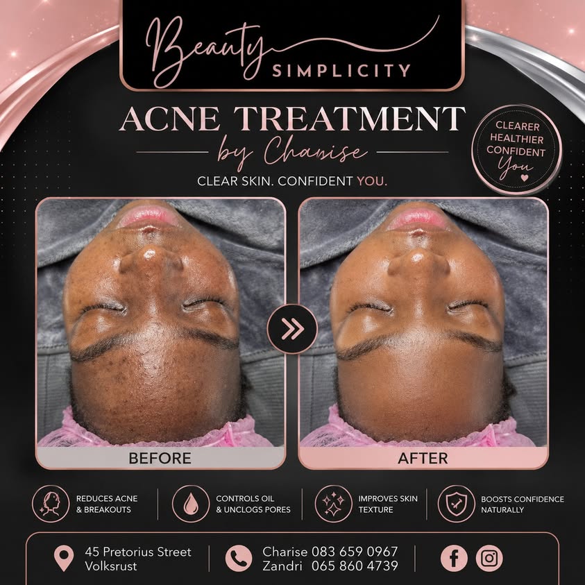 Before and after acne treatment by Charise