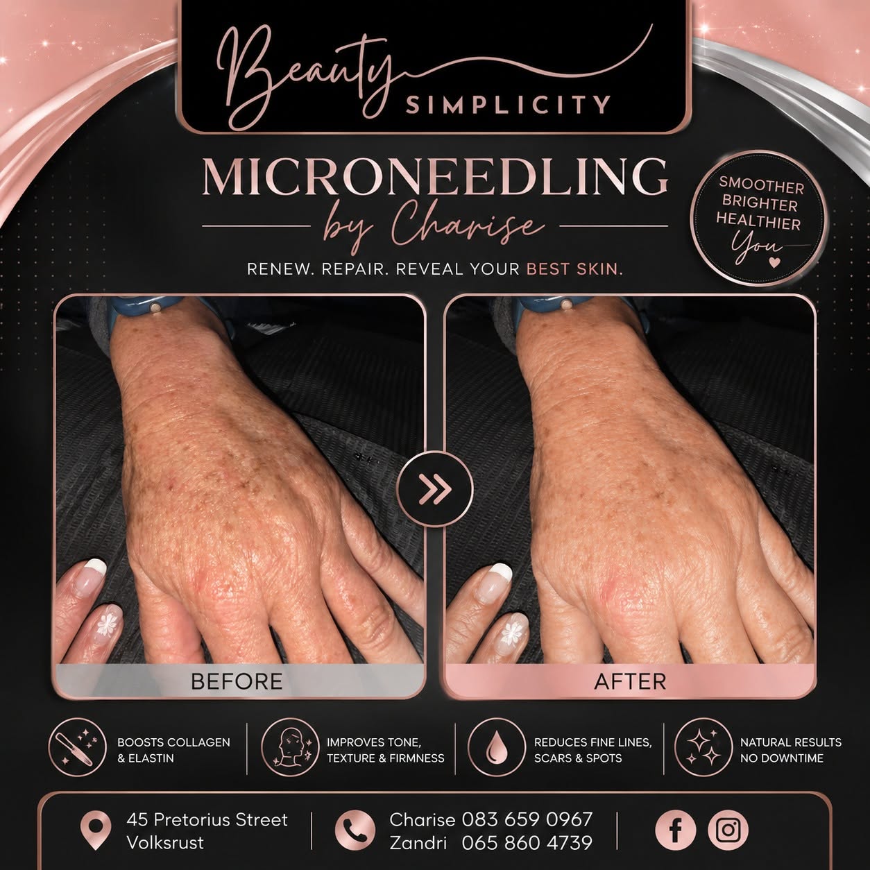 Before and after microneedling by Charise